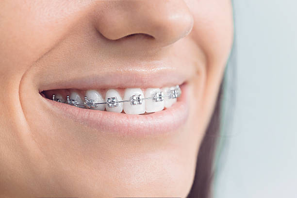 Best Invisalign and Clear Aligners  in Lakewood, SC